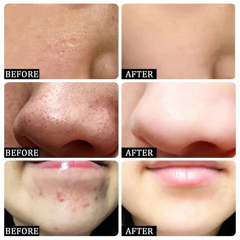 Salicylsäure Poren Clearing Cr – Korean Skincare Routine Bewertung und Preis
